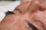 Acupuncture 3