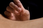 Acupuncture2