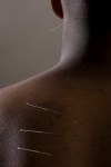 Acupuncture4