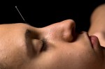 Acupuncture 1